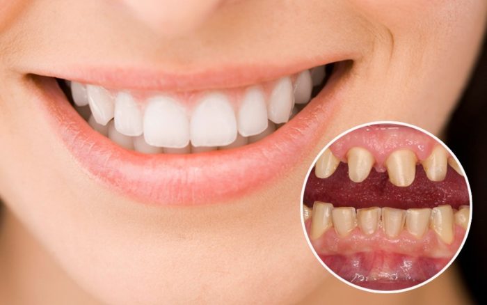 Làm răng sứ giúp bạn có hàm răng trắng đẹp