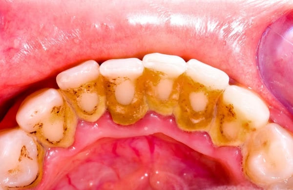 Lấy cao răng có đau không khi chúng bám quá nhiều?