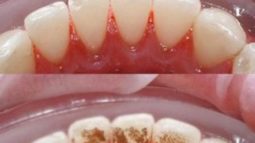 Lấy cao răng có tốt không hay có ảnh hưởng gì đến men răng không?