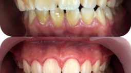 Lưu ngay 4 cách lấy cao răng tại nhà đơn giản và hiệu quả