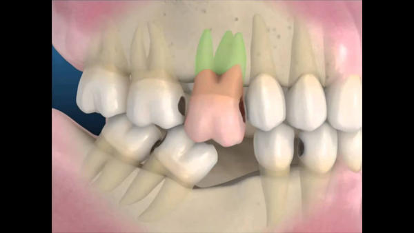 Lưu ý sau khi trồng răng Implant để tránh tiêu xương
