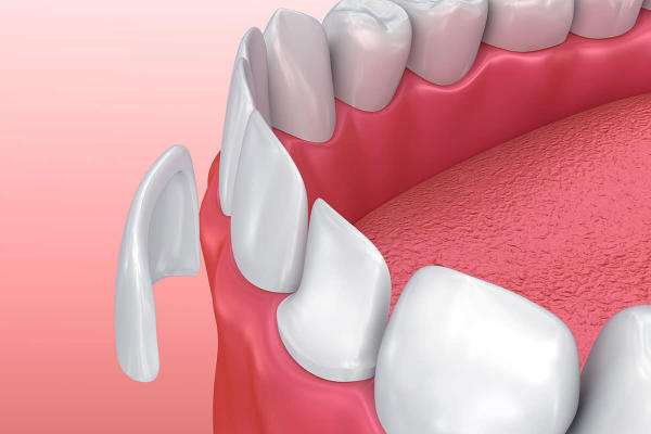 Mặt dán sứ veneer không cần lấy tủy răng khi điều trị