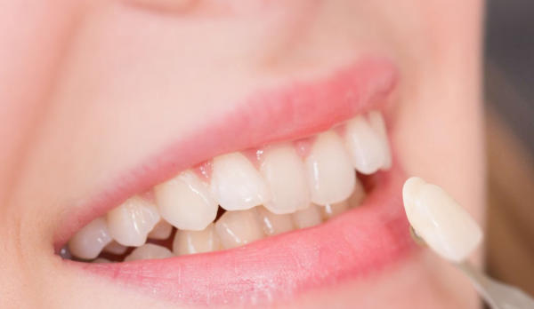 Nếu vệ sinh răng miệng đúng cách mặt dán sứ veneer có tuổi thọ rất bền lâu