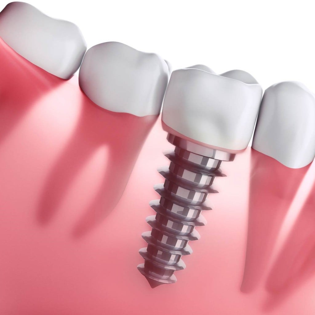 nha-khoa-implant-uy-tin