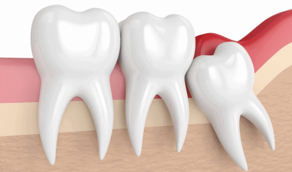 Nhổ răng khôn mọc ngầm giúp hạn chế các vấn đề răng miệng