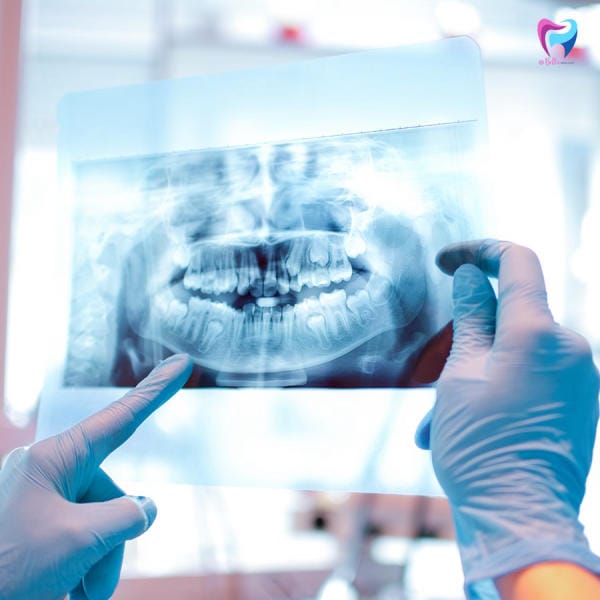 Chụp film giúp quy trình trồng răng Implant diễn ra dễ dàng hơn