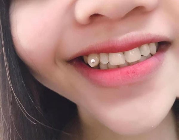 Chọn răng khểnh để làm răng đính đá đẹp sẽ giúp bạn trở nên thu hút hơn
