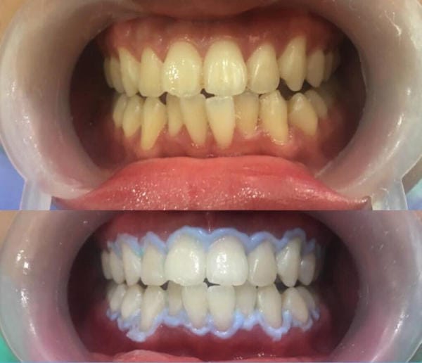 Tẩy trắng răng có tốt không phụ thuộc vào đơn vị nha khoa bạn lựa chọn