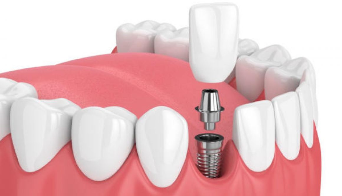 Trồng răng implant toàn hàm, implant toàn hàm all on 4, implant toàn hàm all on 6,