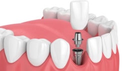 Phân biệt trồng răng implant toàn hàm All on 4 và All on 6