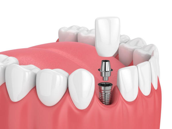 Trồng răng Implant có đau không phụ thuộc vào đơn vị nha khoa uy tín