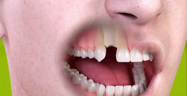 Ưu điểm của trồng răng Implant giúp phục hình vấn đề mất răng toàn diện