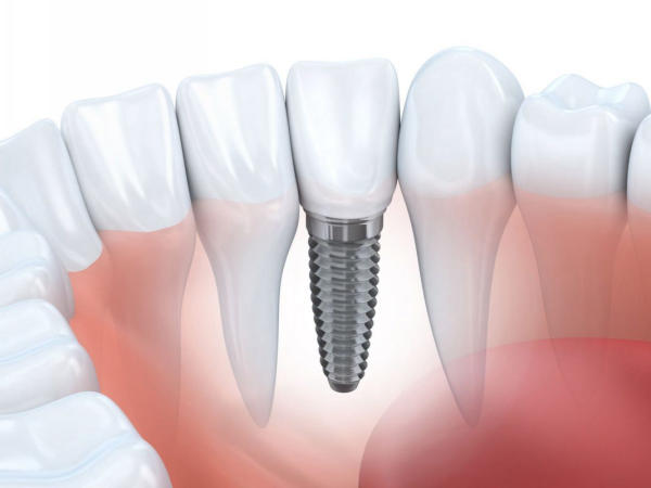 Ưu điểm của trồng răng Implant là phục hình răng nhưng không tác động đến răng bên cạnh