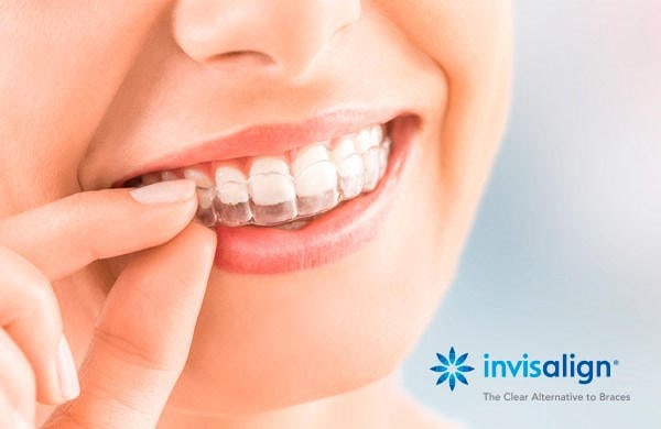 Niềng răng trong suốt Invisalign được đánh giá là một trong các loại niềng răng mang lại hiệu quả tốt