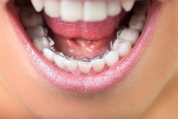 Niềng răng mặt lưỡi giúp bạn không bị phát hiện đang niềng răng