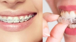Tìm hiểu các loại niềng răng được ưa chuộng nhất hiện nay