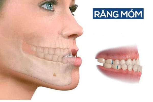 Niềng răng hô hàm dưới giúp cân chỉnh lại gương mặt