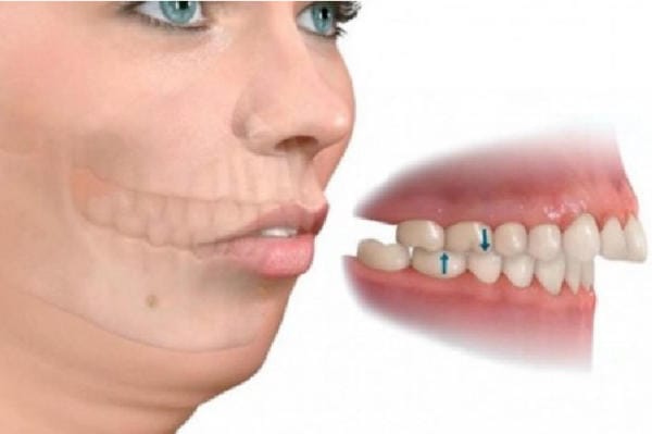 Để chữa răng vẩu có 2 phương pháp niềng răng hô hàm trên phổ biến.