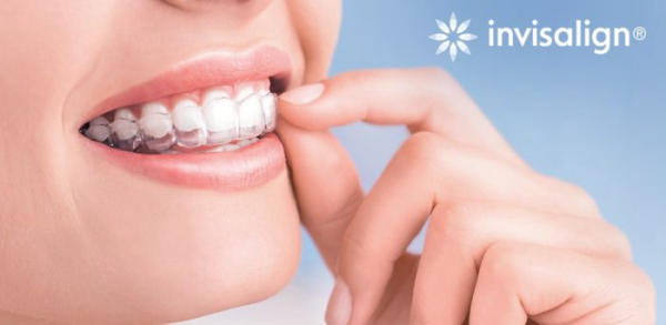 Niềng răng trong suốt Invisalign mang đến hiệu quả chỉnh nha vượt trội