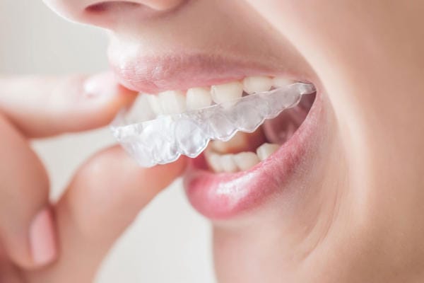 Niềng răng trong suốt Invisalign mang lại cảm giác thoải mái cho người sử dụng