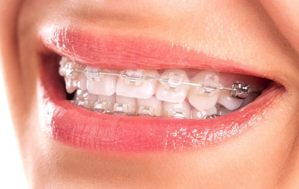 Niềng răng mắc cài kim loại chắc chắn và ổn định, không dễ gãy vỡ