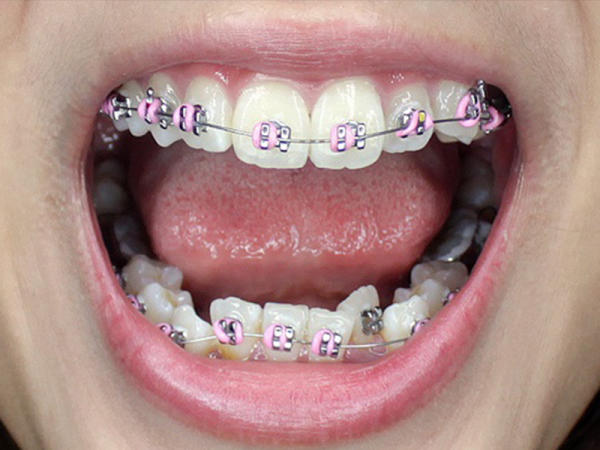 Thời gian điều trị bằng niềng răng mắc cài kim loại diễn ra nhanh chóng