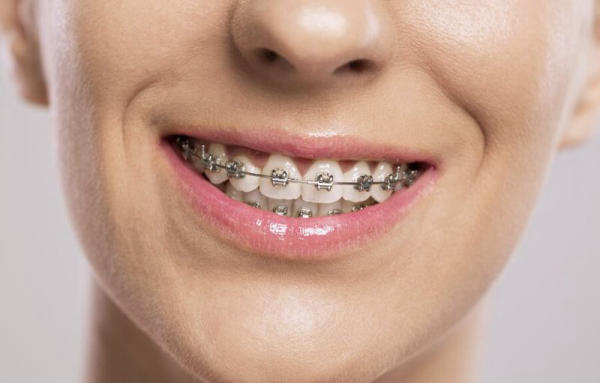 Niềng răng mắc cài kim loại mang lại hiệu quả chỉnh nha tuyệt vời