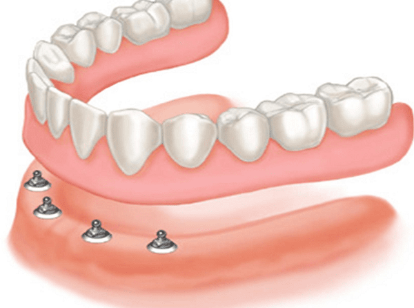 Trồng răng implant là phương pháp phục hồi răng tốt nhất