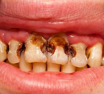 Răng bị yếu và giòn do sâu răng