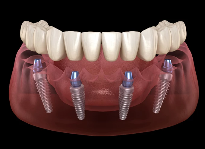Trồng răng implant toàn hàm All on 4 và All on 6