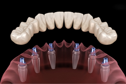 Trồng răng implant toàn hàm All on 46