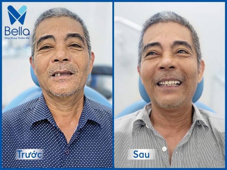 Ưu điểm của trồng răng implant toàn hàm All on 4 và All on 6 là tự nhiên như răng thật