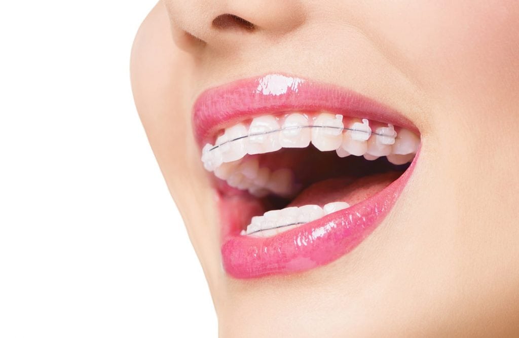 Các phương pháp niềng răng 1 hàm