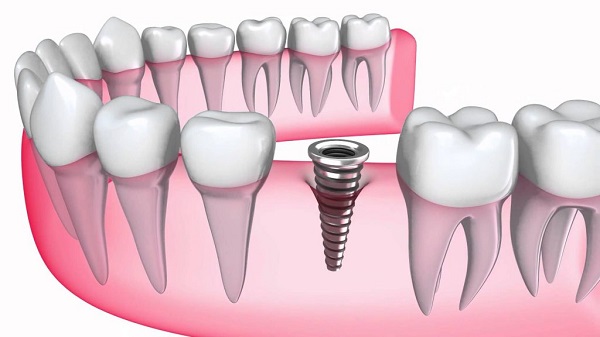 Quá trình trồng răng implant có đau không?