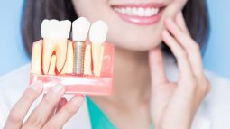 Trồng răng implant có đau không? Cách giảm đau sau khi cấy ghép implant