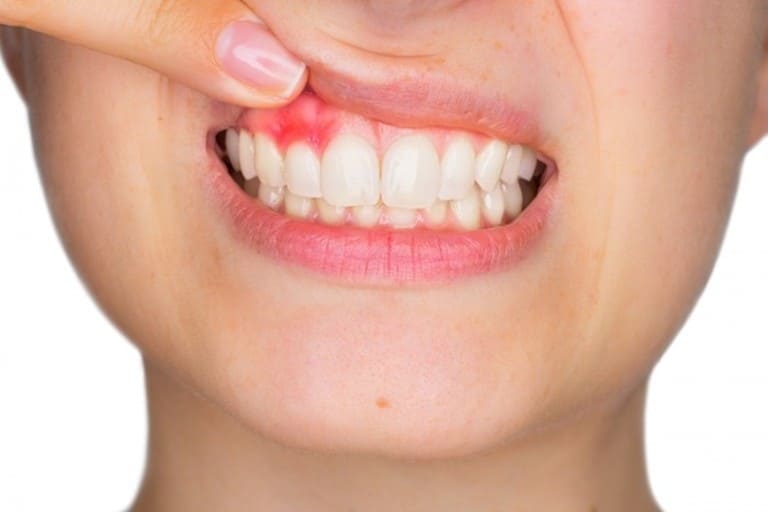 Trồng răng implant mất bao lâu còn phụ thuộc vào tình trạng sức khỏe răng miệng