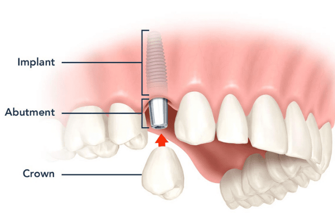 Trồng răng implant mất bao lâu được chia làm 3 giai đoạn