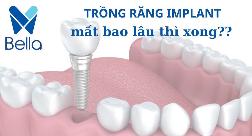 trong rang implant mat bao lau