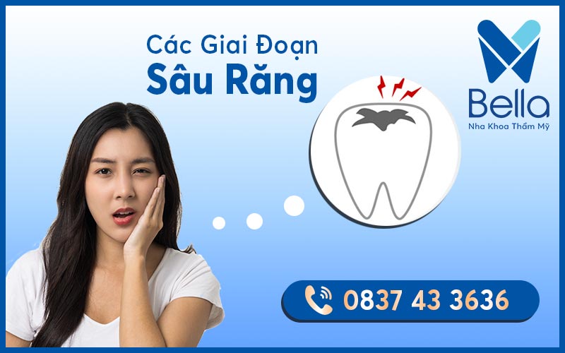 4 giai đoạn của sâu răng