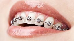 Những lý do niềng răng mắc cài kim loại vẫn được ưa chuộng