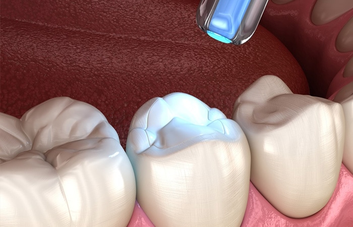 những giai đoạn của sâu răng vfa cách điều trị