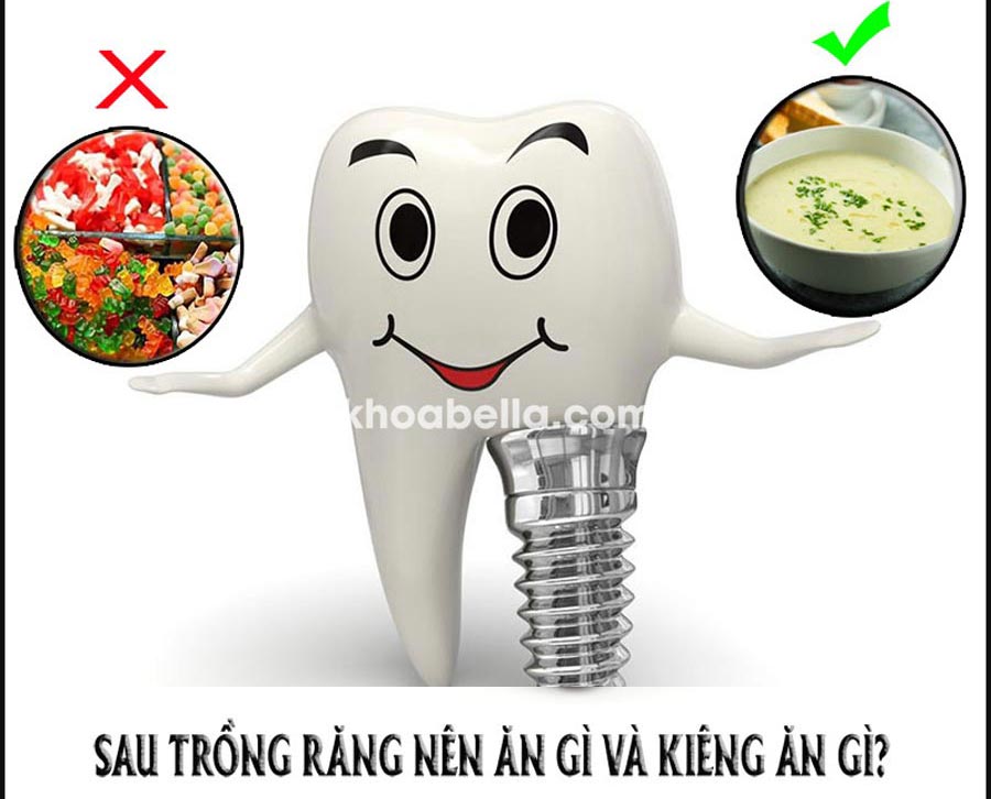 Sau trồng răng implant kiêng ăn gì