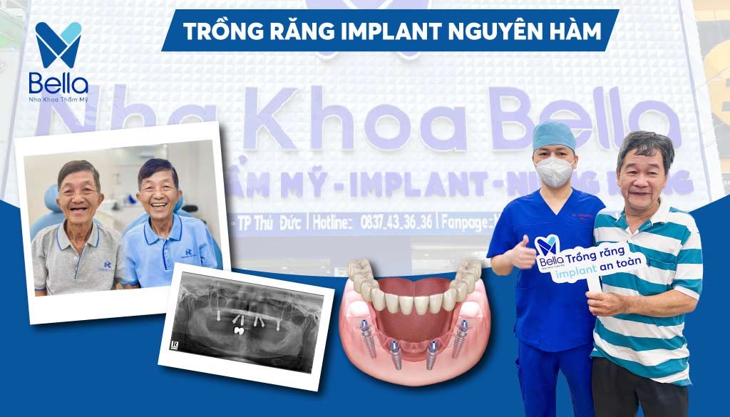 giá trồng răng implant nguyên hàm