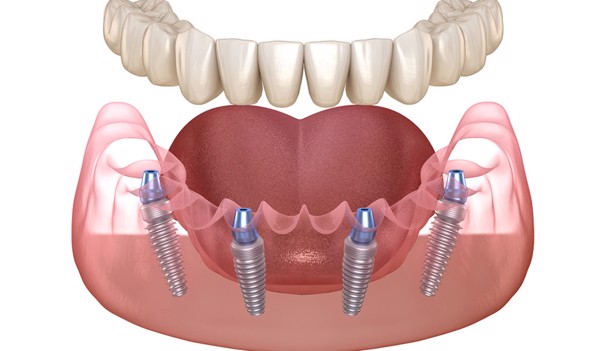 Giá trồng răng Implant nguyên hàm All-on-4