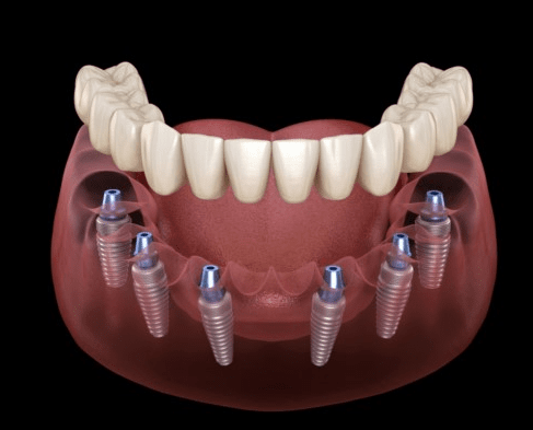 Giá trồng răng Implant nguyên hàm All-on-6