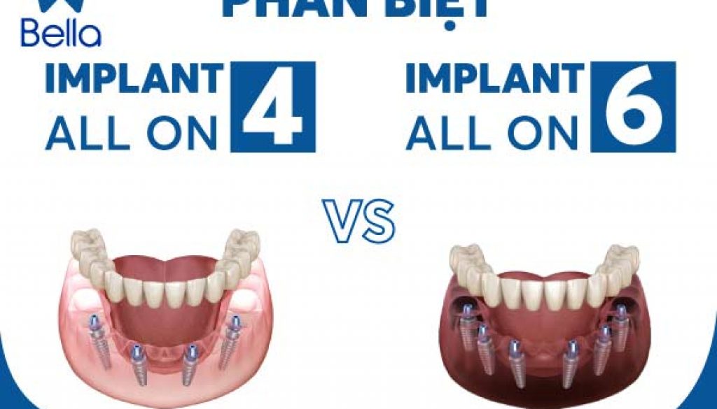 implant-all-on-4