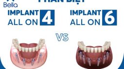 Phân biệt trồng răng Implant toàn hàm All on 4 và All on 6