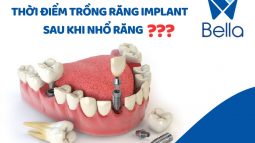 Nhổ răng bao lâu thì trồng implant? Trồng răng implant ở đâu uy tín?