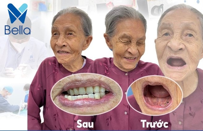 Cụ Màu - trồng răng implant toàn hàm All on 4