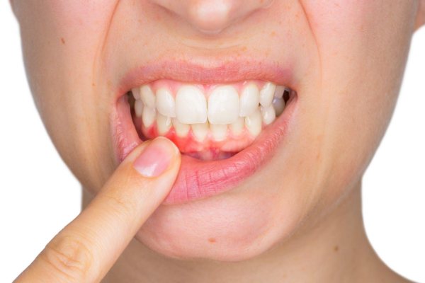 Trồng răng implant ăn gì để tránh biến chứng?